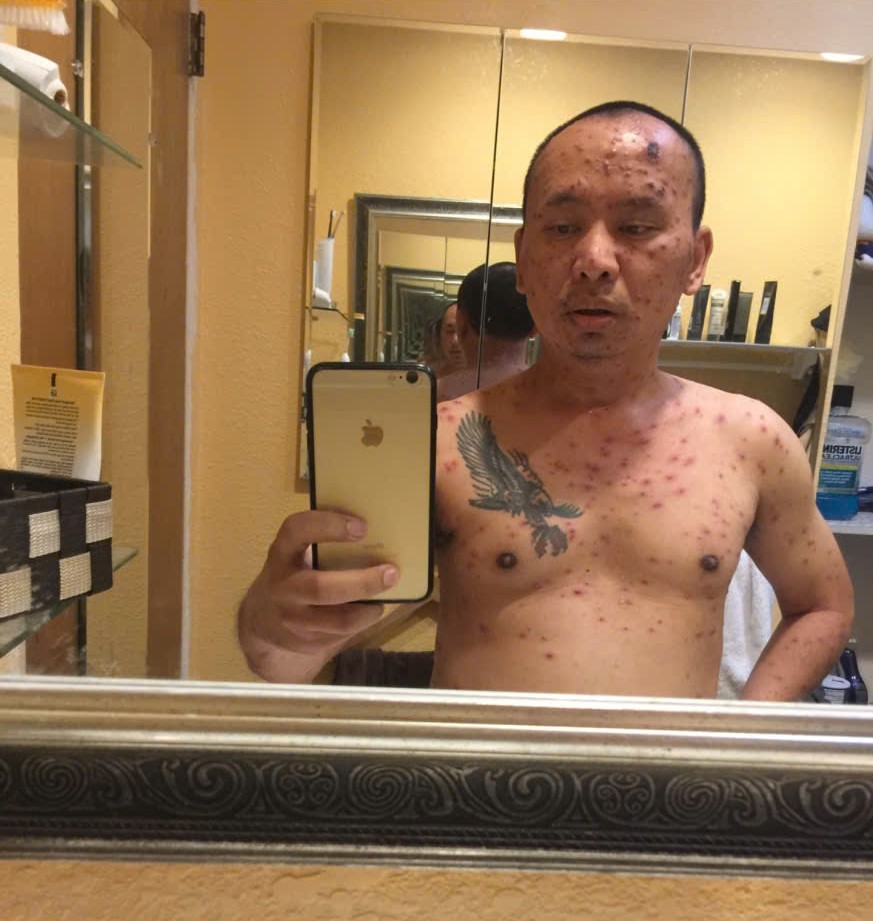 Sự tàn phá của căn bệnh